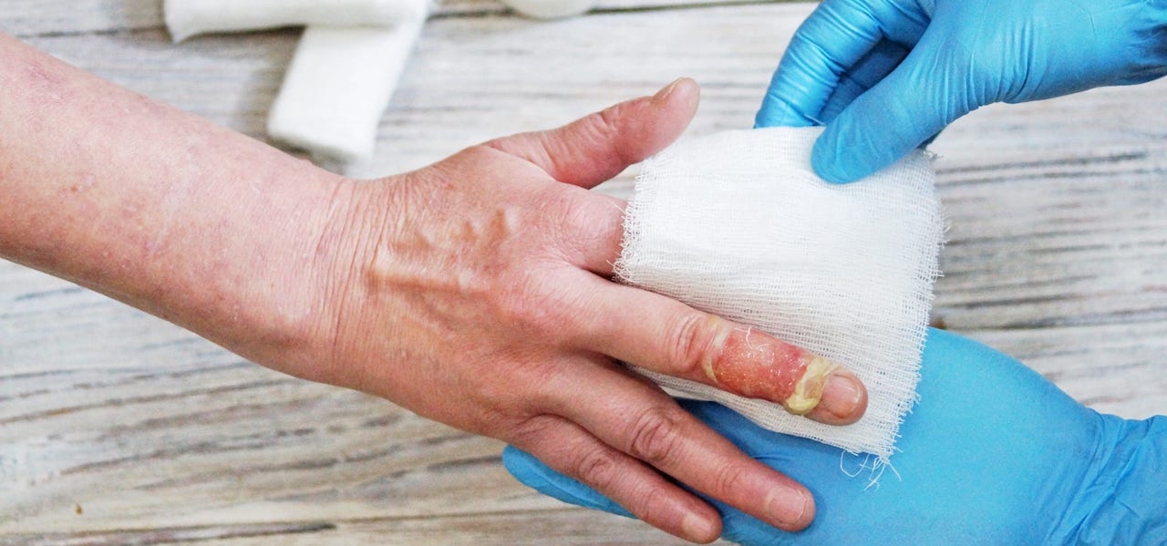 Burn Injury